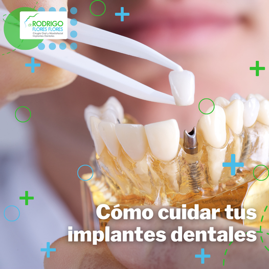 Como Cuidar Tus Implantes Dentales.